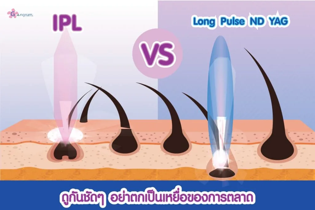 เลเซอร์ขนรักแร้ ipl vs ND yag
