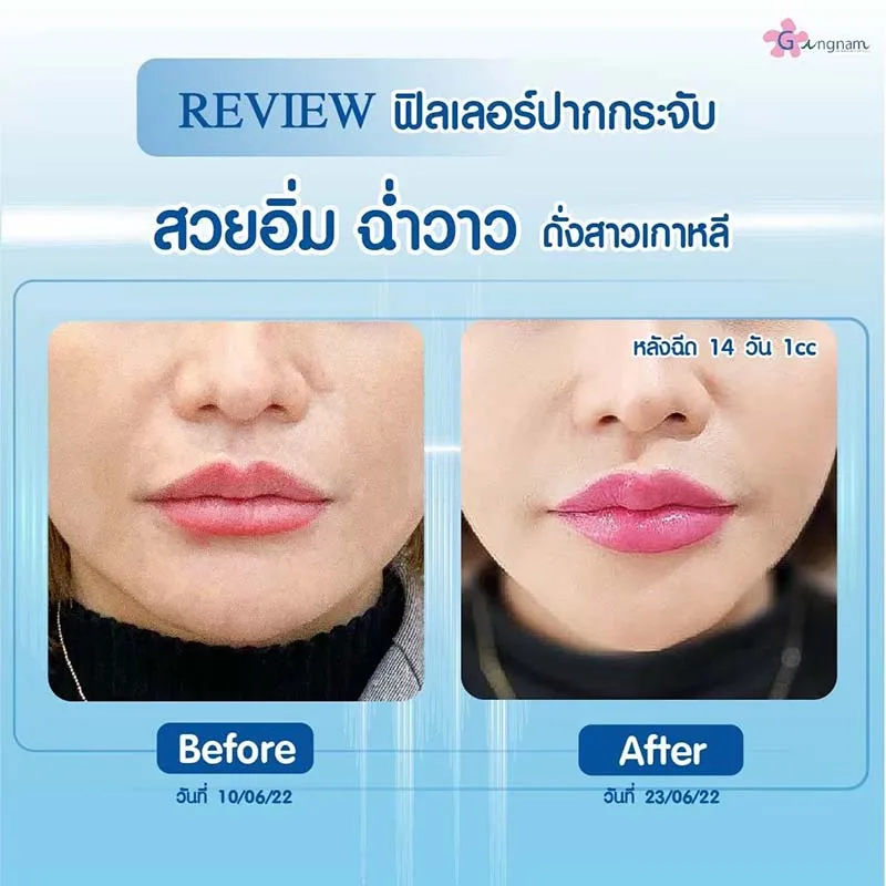 รีวิวฉีดฟิลเลอร์ปากกระจับ สวยๆ