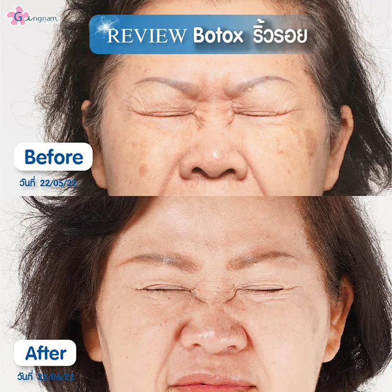 Botox ริ้วรอย