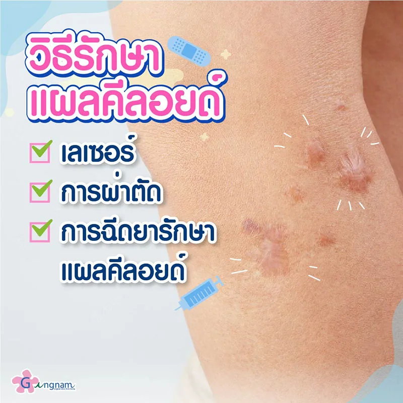 รักษาแผลคีลอยด์ด้วยวิธีไหนดี