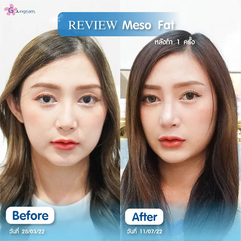 รีวิวฉีดแฟตลดเหนียง