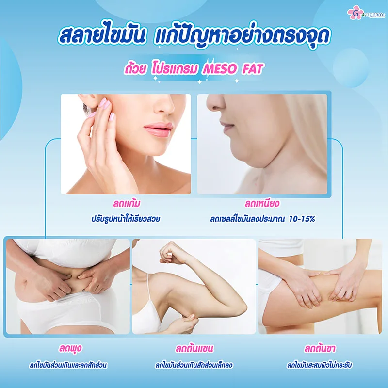 ตำแหน่งฉีดแฟต ที่ออกฤทธิ์แล้วได้ผล
