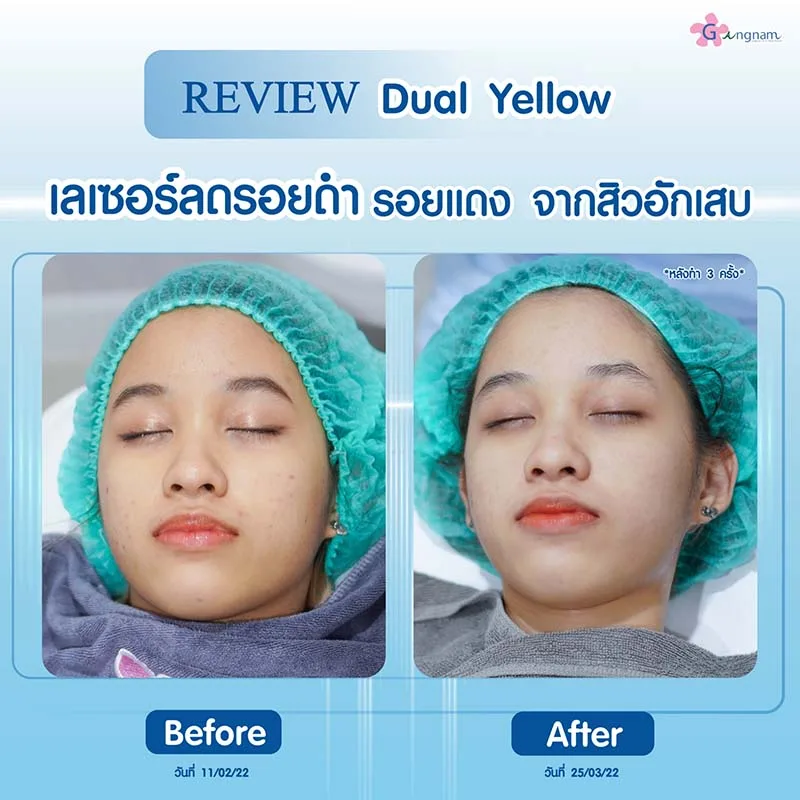 เลเซอร์ลดรอยดำ รอยแเดง จากสิวอักเสบ