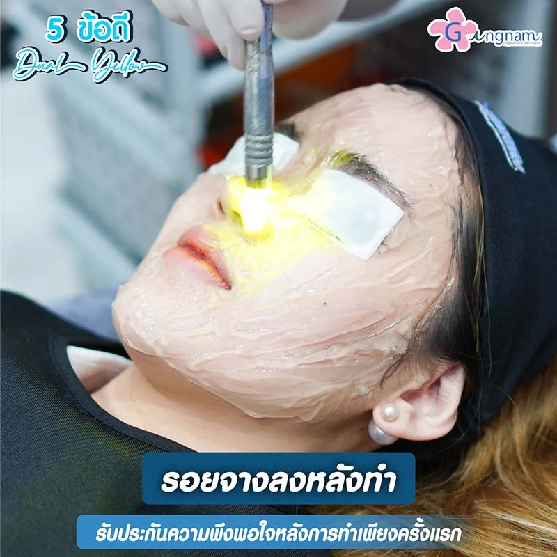 เลเซอร์รอยสิว กี่ครั้งเห็นผล