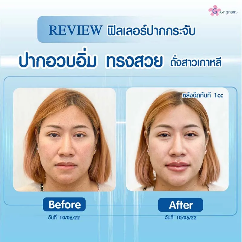 การฉีดฟิลเลอร์แก้ปัญหาในคนที่ปากบาง
