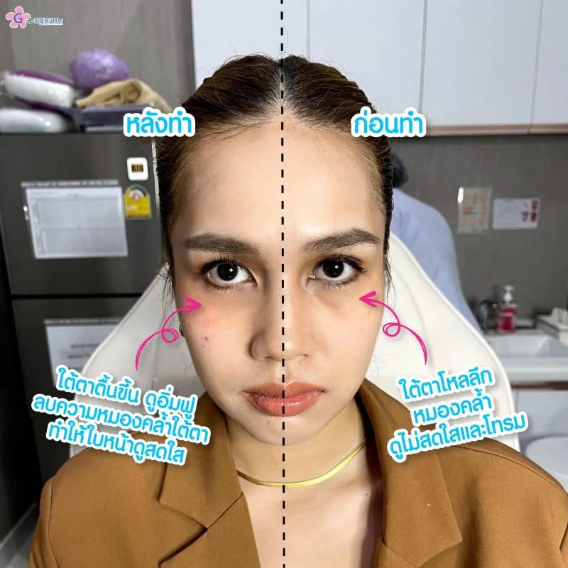 ฟิลเลอร์ใต้ตาข้อดี