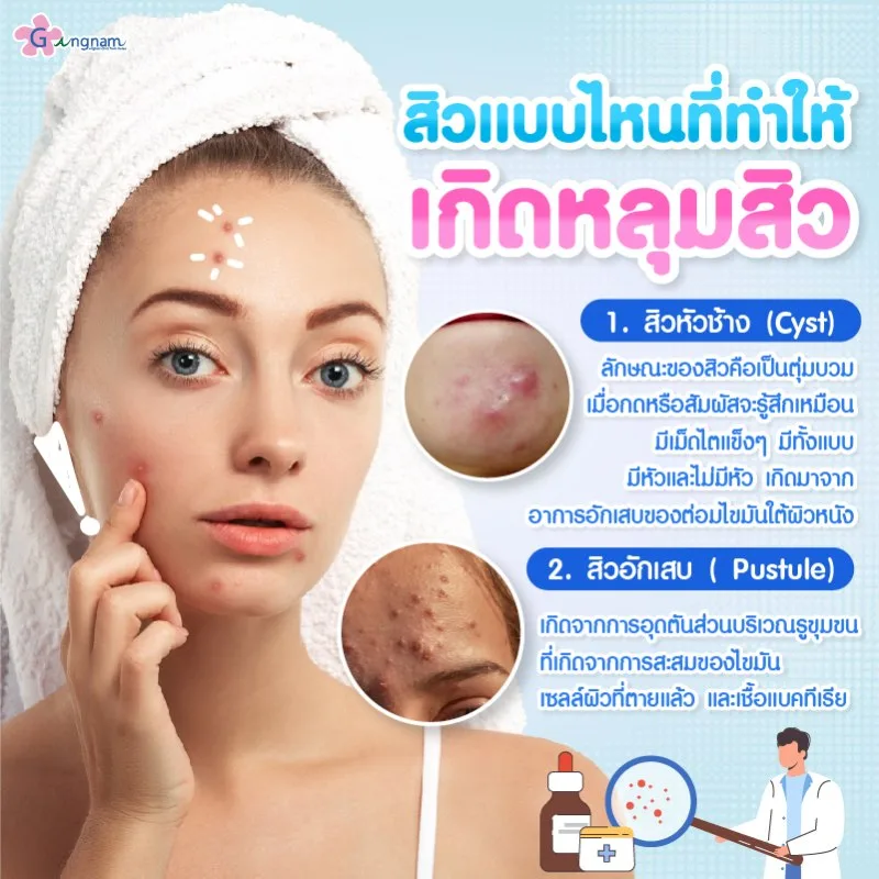 หลุมสิวเกิดจากสิวแบบไหน