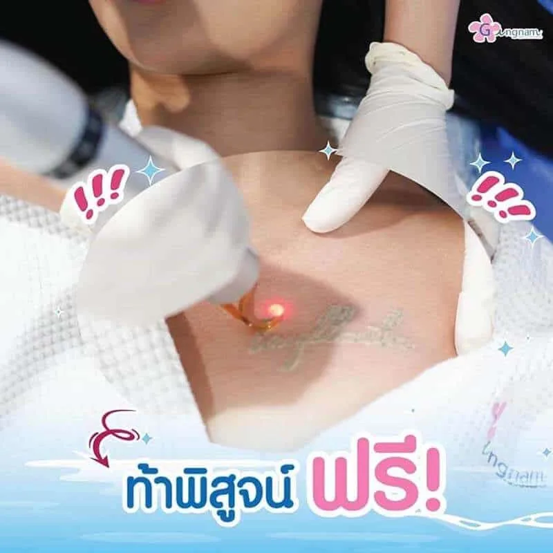 ทดลองลบรอยสักด้วยเลเซอร์ครั้งแรก