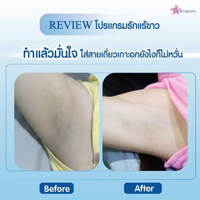 ผลลัพธ์หลังเลเซอร์รักแร้ขาว