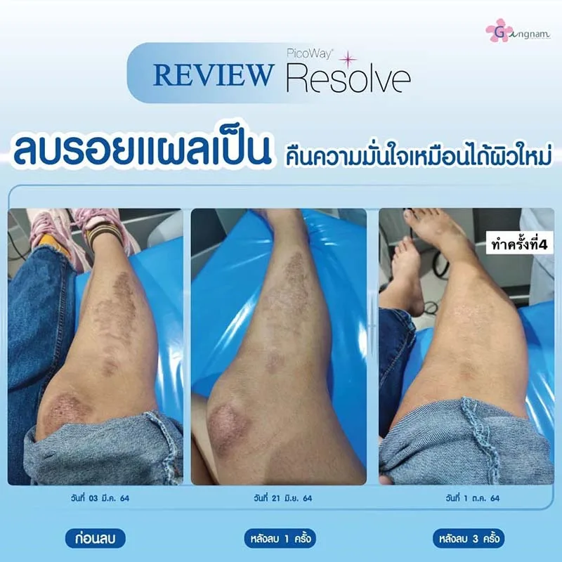 picoway laser ลบรอยแผลเป็น
