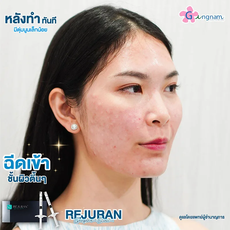 ผลข้างเคียงและอาการหลังฉีดรีจูรัน