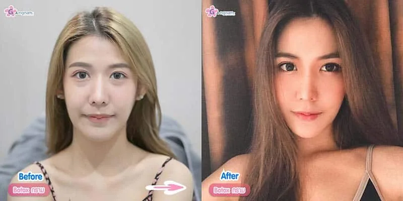 รีวิวโบท็อกลดกราม หน้าเรียว