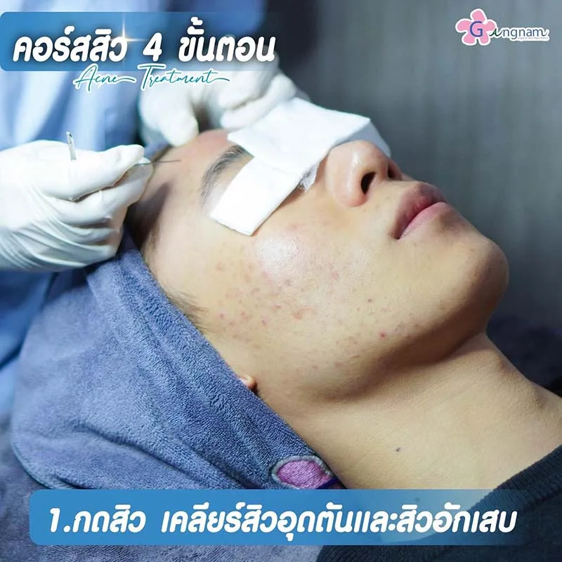 กดสิวหน้าผาก