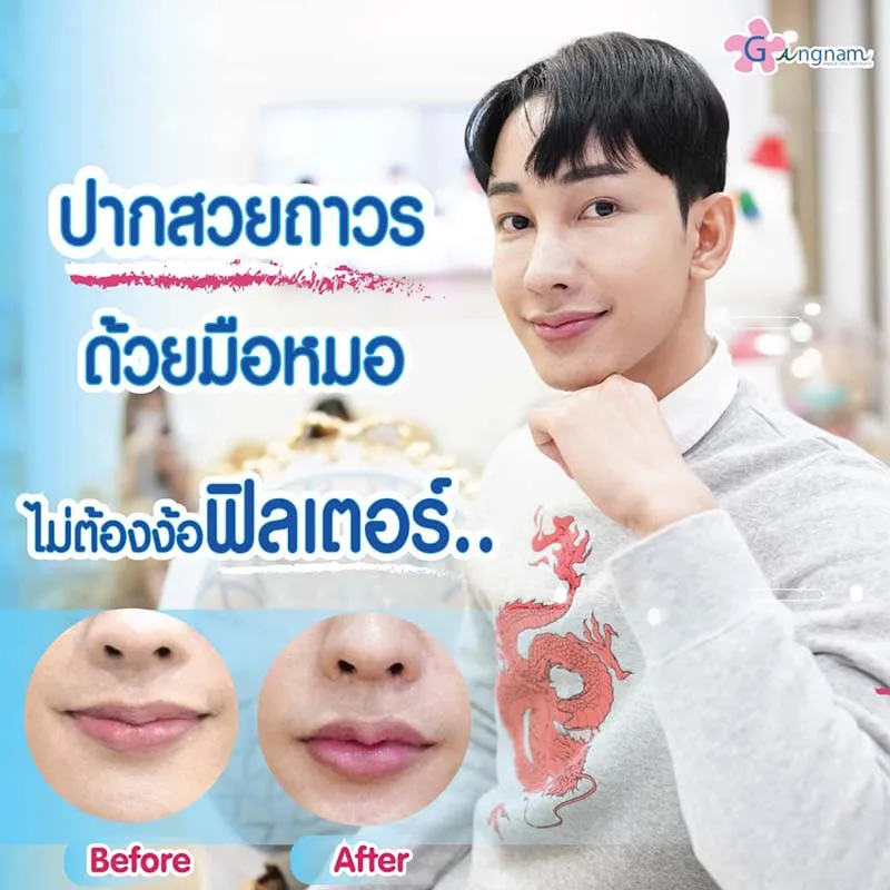 ปรับรูปทรงปากด้วยฟิลเลอร์