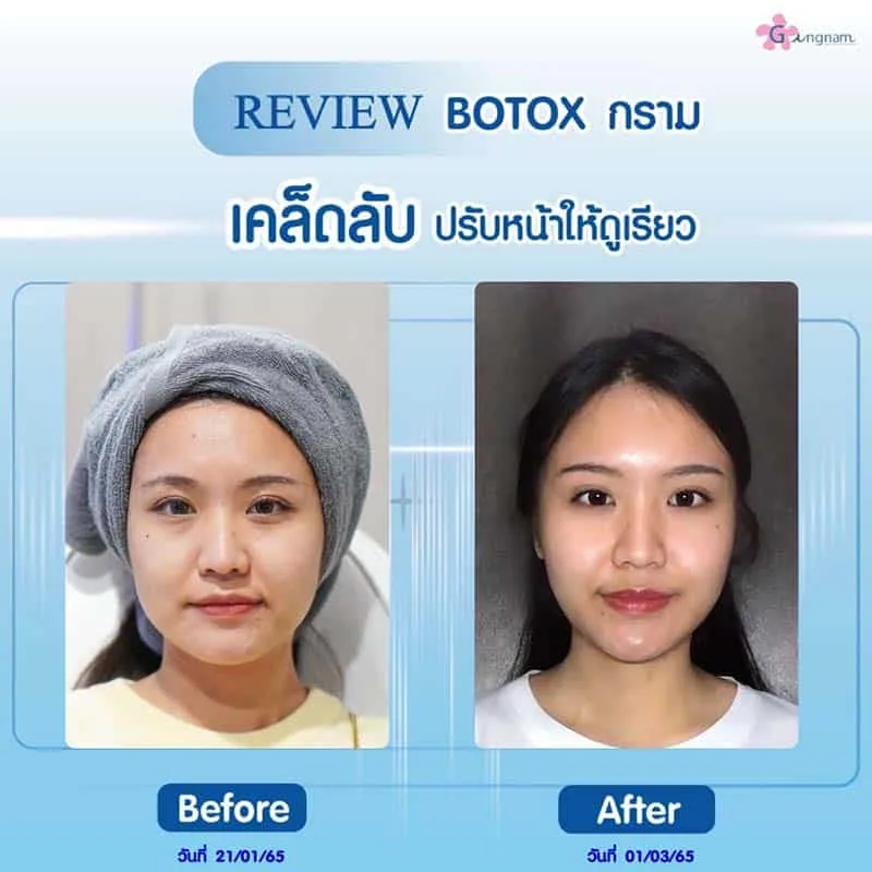 หลังฉีดโบท็อกลดกล้ามเนื้อบริเวณกราม