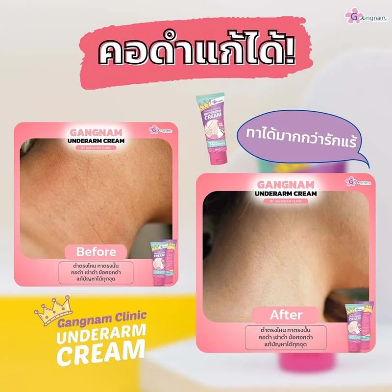 ทาครีมแก้คอดำ