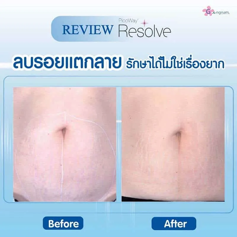 รีวิวเลเซอร์ลบรอยแตกลาย
