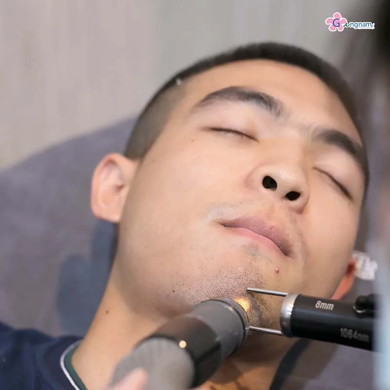 เลเซอร์กำจัดหนวดผู้ชาย