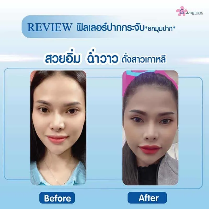 ฉีดฟิลเลอร์ แต่ละจุดช่วยเรื่องอะไร ครบทุกเรื่อง ที่ควรรู้ก่อนฉีดครั้งแรก 2025