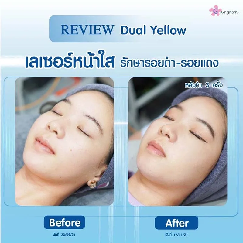 เลเซอร์หน้าใส รักษารอยดำ-รอยแดง