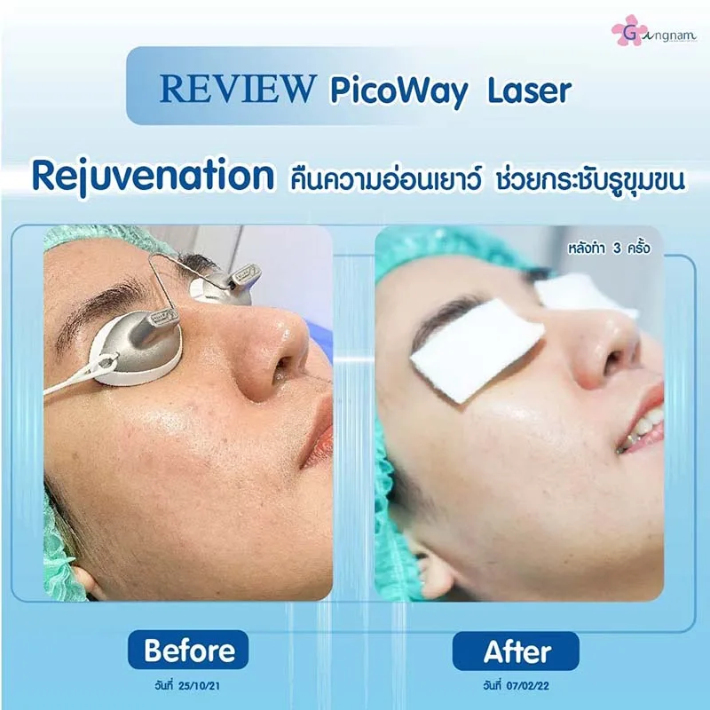 รีวิว rejuvenation แก้รอยสิวบนใบหน้า
