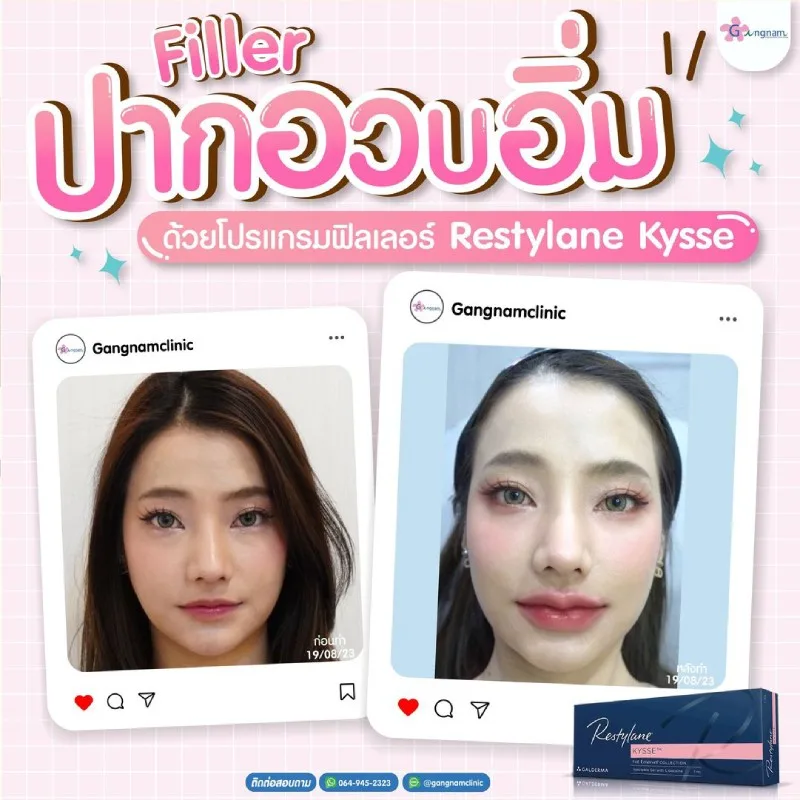 Review Restylane Kysse