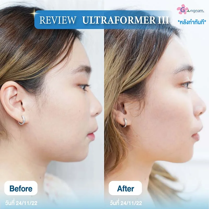 รีวิวยกกระชับ Ultraformer III