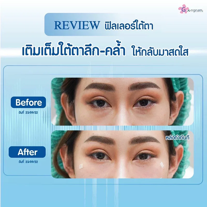ฉีดฟิลเลอร์ใต้ตา แก้ใต้ตาลึก-คล้ำ