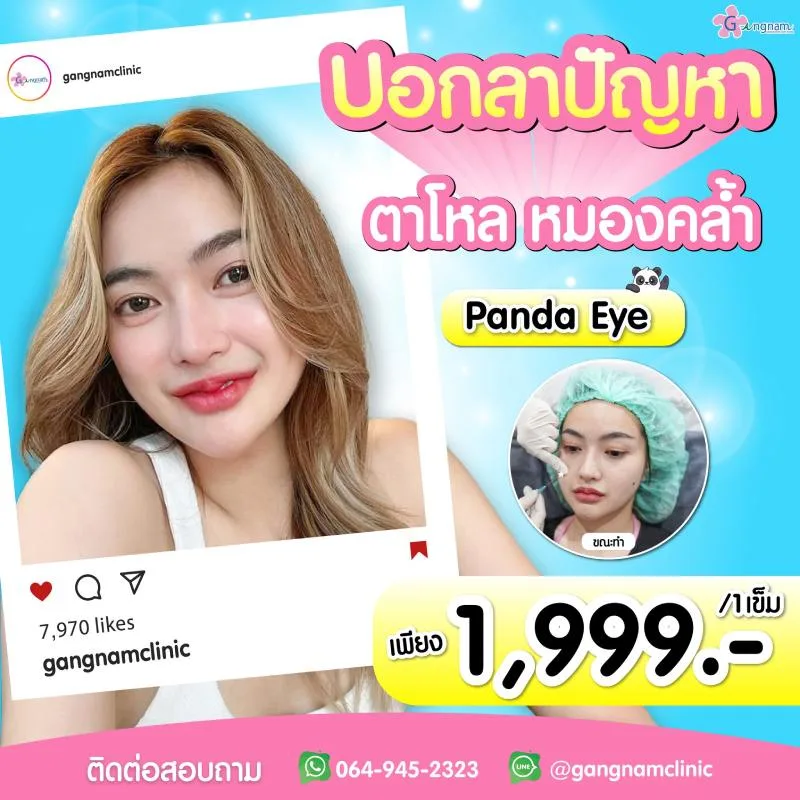 ร้อยไหมใต้ตาราคา กังนัมคลินิก