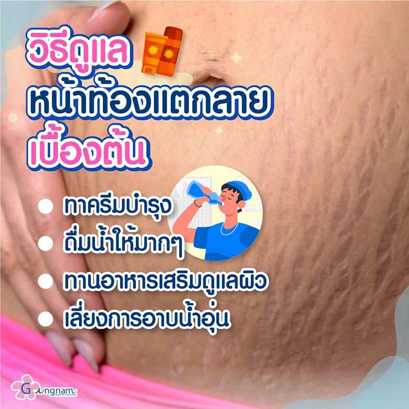 วิธีรักษาหน้าท้องแตกลาย