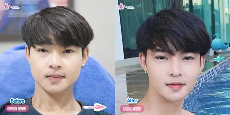 ฉีดโบท็อกลดกรามผู้ชาย
