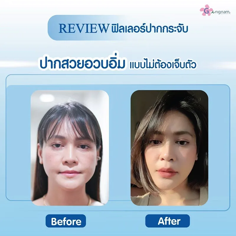 การฉีดฟิลเลอร์ปาก ให้อวบอิ่ม