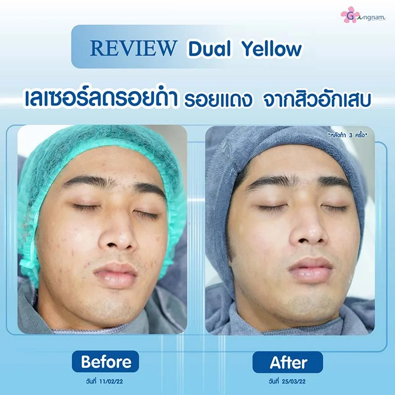 Dual Yellow laser ลดรอยสิว