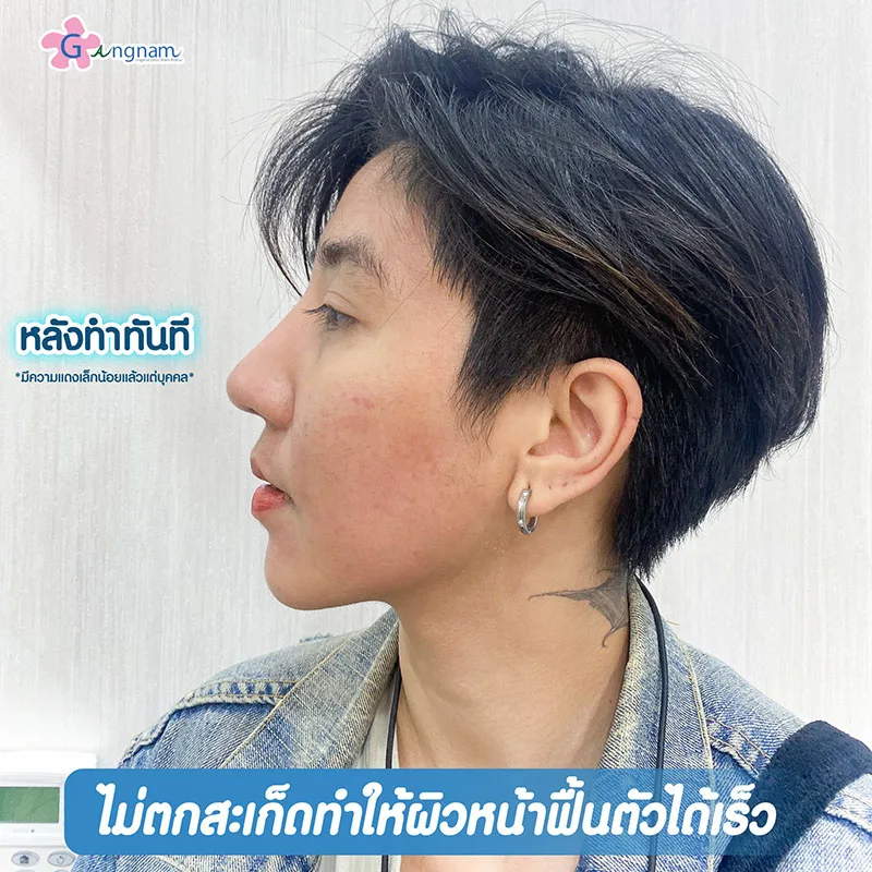 อาการและผลข้างเคียงหลังเลเซอร์หลุมสิว