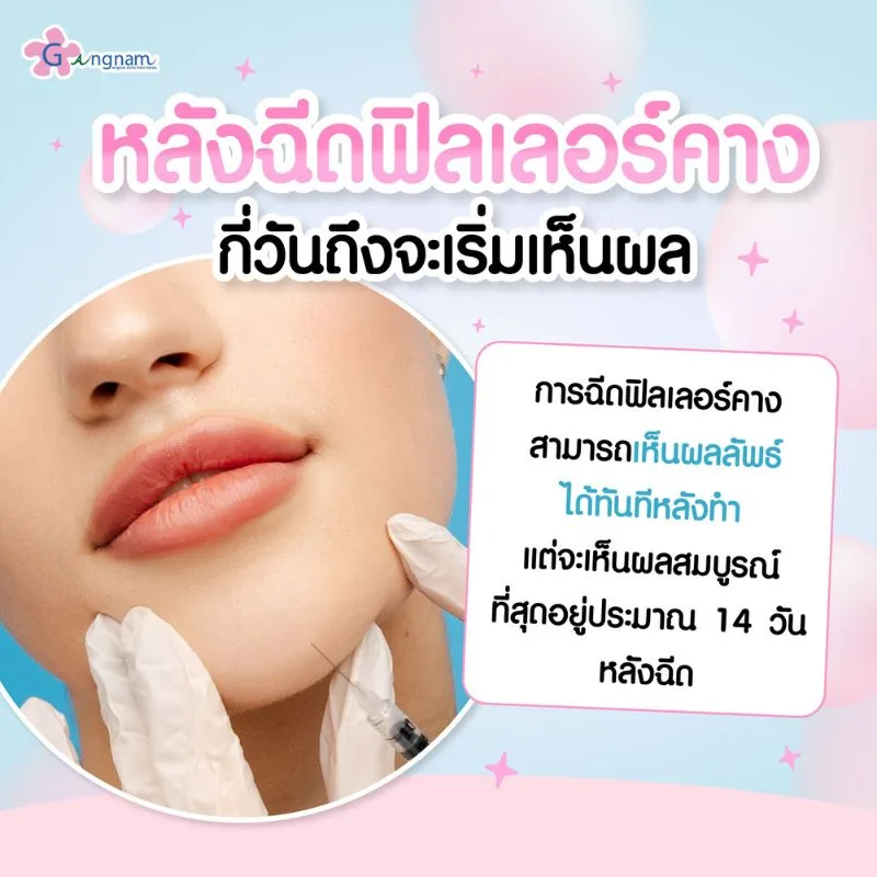 หลังฉีดฟิลเลอร์คางกี่วันจะเห็นผล
