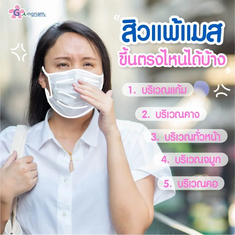 สิวแพ้แมสขึ้นตรงไหนได้บ้าง