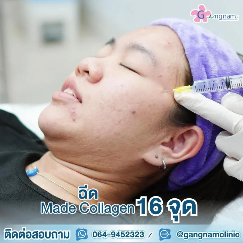 ฉีดมาเด้คอลลาเจน