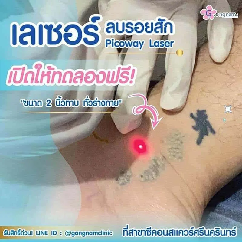โปรโมชั่นลบรอยสักฟรี ขนาด 2 นิ้วทาบ