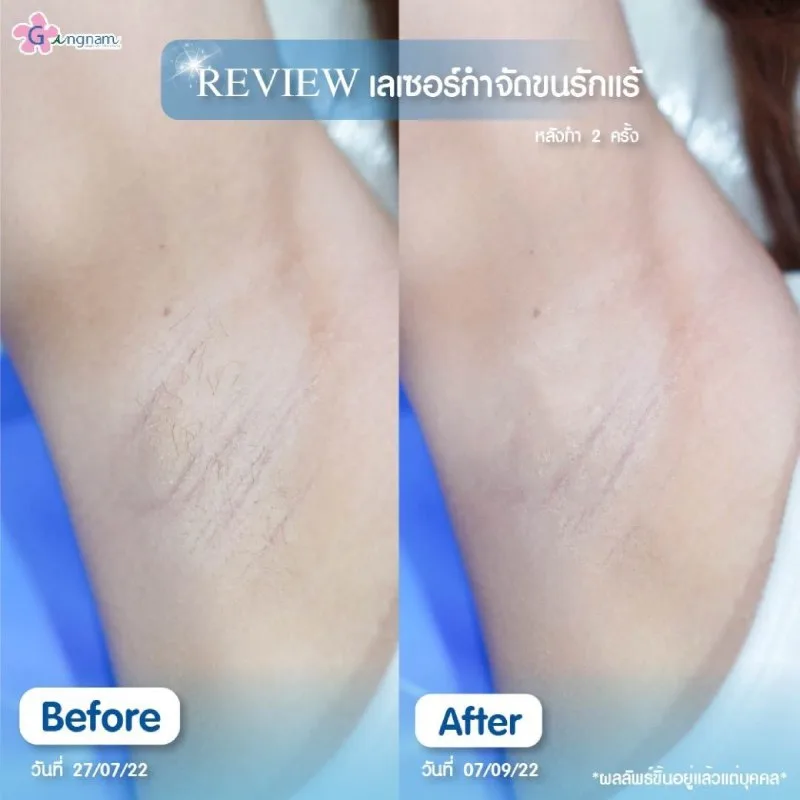 ใช้แสงเลเซอร์ลบรอยพับรักแร้ เหมาะกับใคร