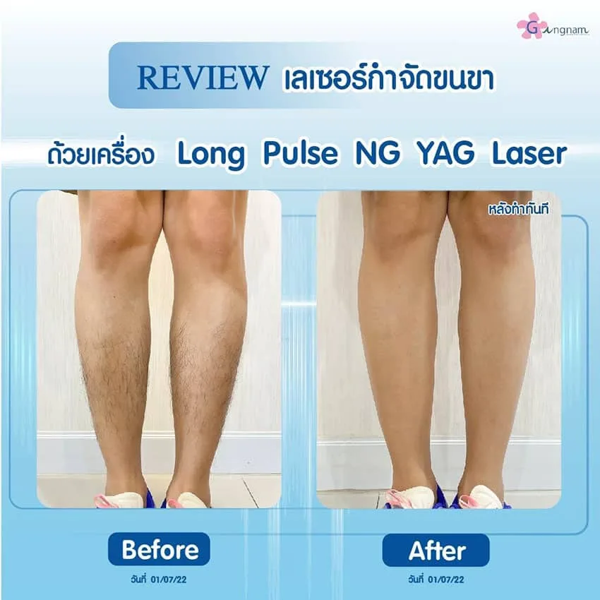 เลเซอร์ขนขา