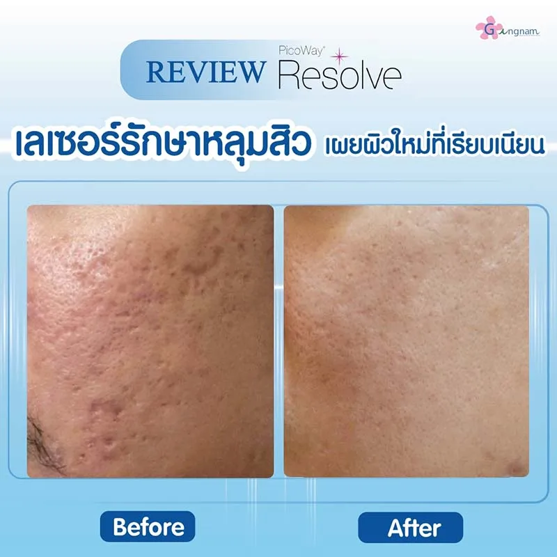 picoway laser รักษาหลุมสิว