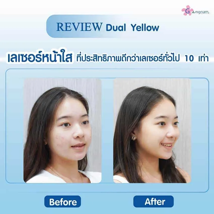 รีวิว Dual Yellow laser บำรุงผิวหน้า
