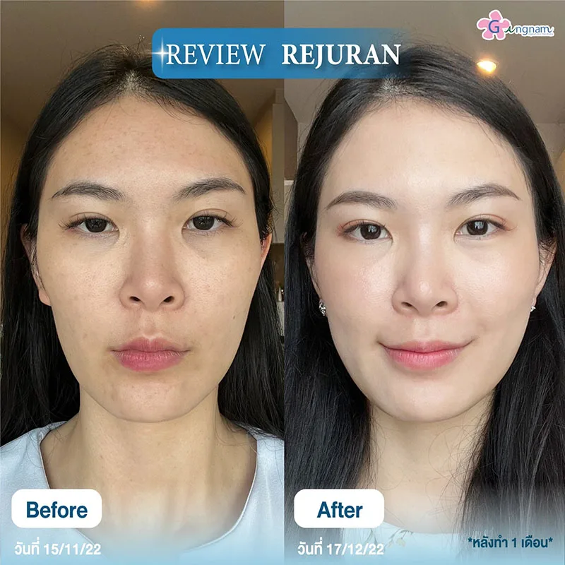 รีวิวฉีดรีจูรัน