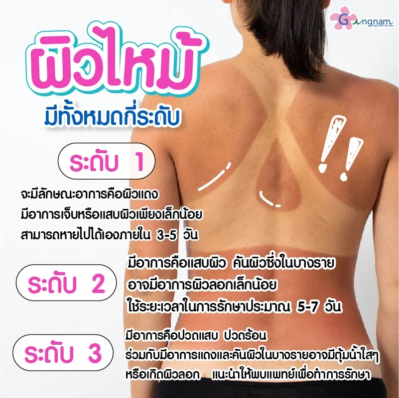 ผิวไหม้มีทั้งหมดกี่ระดับ