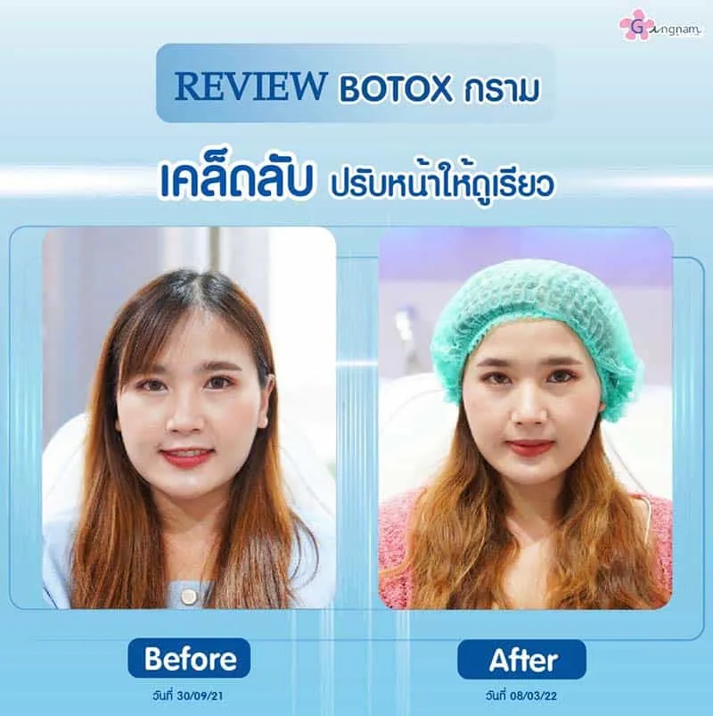 ลักษณะใบหน้าที่ฉีดโบลดกรามได้ผล