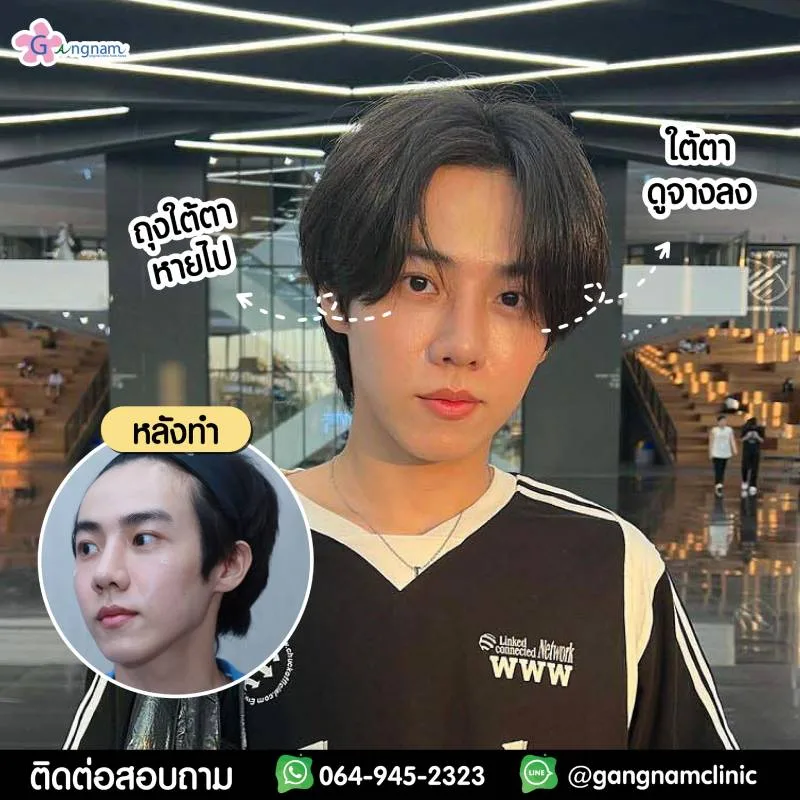 PANDA EYE หลังทำ