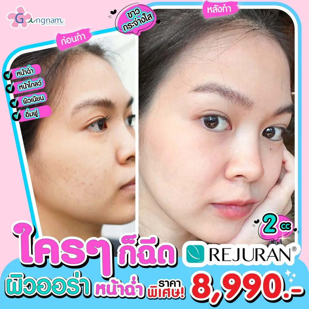 ฉีด Rejuran