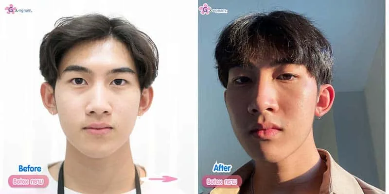รีวิว botox กราม ผู้ชาย