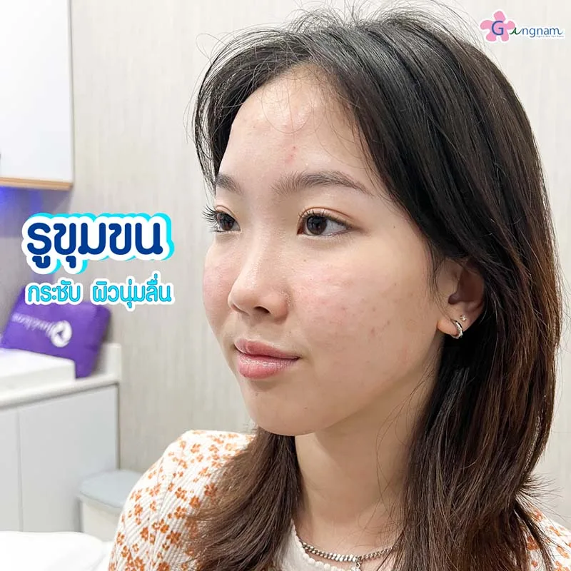 กระชุับรูขุมขนให้ผิวนุ่มลื่น