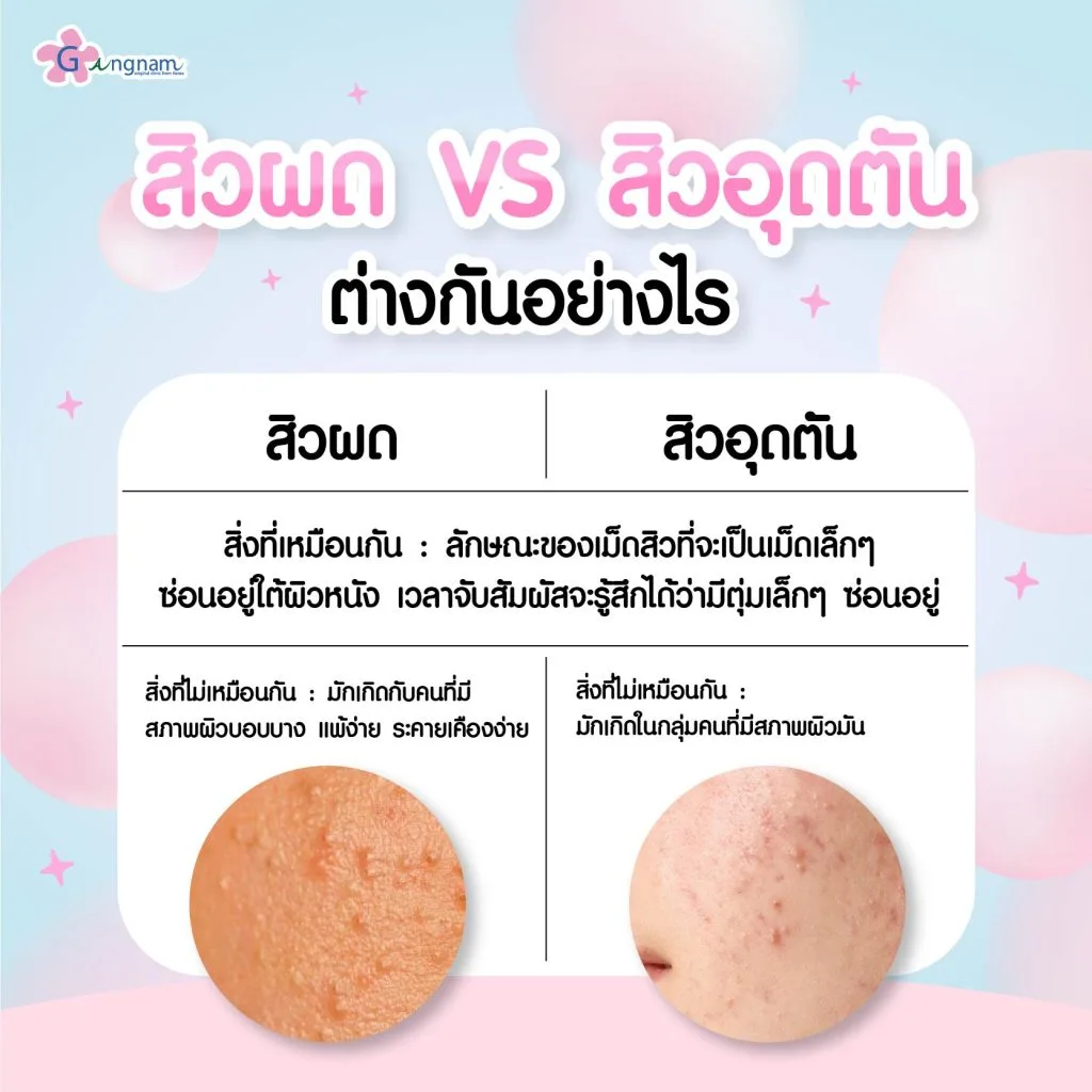สิวผดต่างกับสิวอุดตันอย่างไร